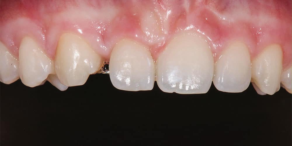 CASUS 11: herstel van een misvormde tand na ongeval