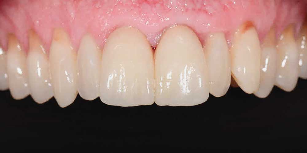 CASUS 14: tandvleescorrectie en nieuwe porseleinen kronen