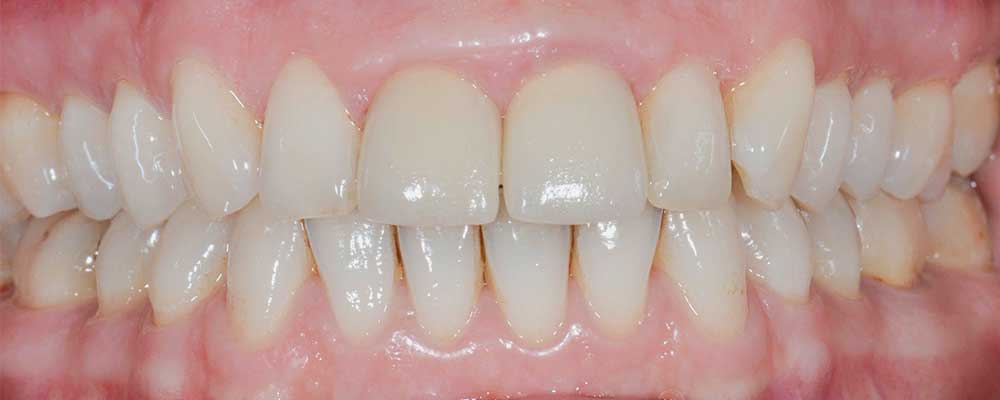 CASUS 15: kronen weer in verhouding na tandvleescorrectie