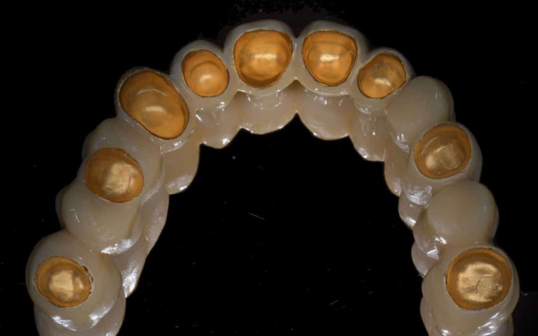 Reconstructie van ontbrekende tanden