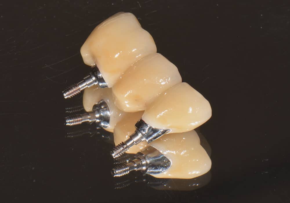 CASUS 21: reconstructie van ontbrekende tanden