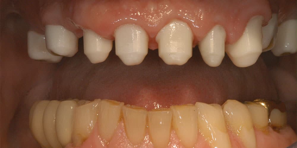 CASUS 21: reconstructie van ontbrekende tanden